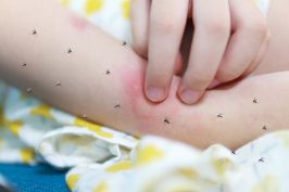 Little girl has skin rash allergy and itchy on her arm from mosquito bite