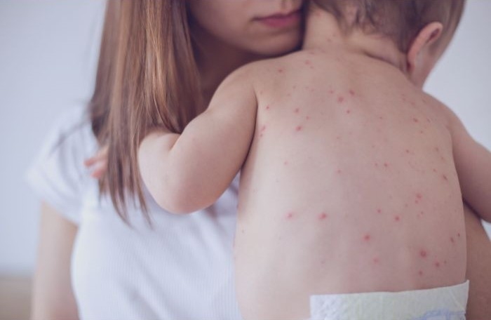Departamento de salud aclara dudas sobre contagio de sarampión